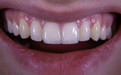 White Spots on Teeth? Discover Causes & Effective Treatments